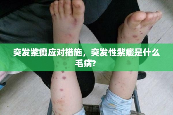 突发紫癜应对措施,突发性紫癜是什么毛病?